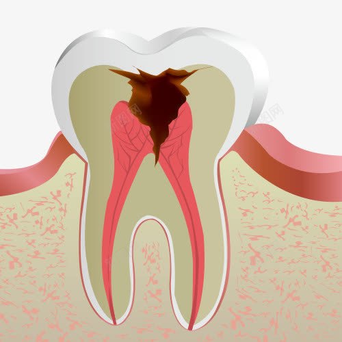 蛀牙牙痛坡面图png免抠素材_88icon https://88icon.com 牙医医生 牙痛 牙齿治疗 牙齿疼痛 蛀牙