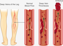 静脉瓣静脉曲张矢量图高清图片