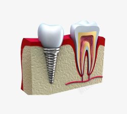 种植牙齿素材
