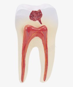 牙齿蛀牙素材