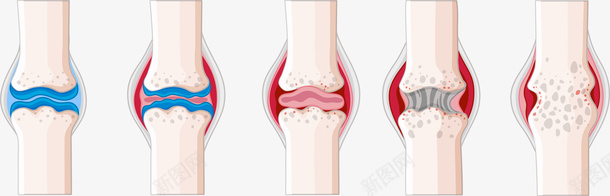 骨头病变效果矢量图eps免抠素材_88icon https://88icon.com 医疗 病变 矢量素材 骨头 骨质 矢量图