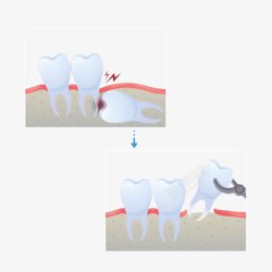 手绘蛀牙拔牙素材