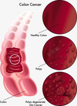 人体肠癌医学分析图素材