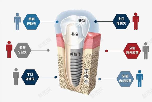 牙齿分解图png免抠素材_88icon https://88icon.com 保护牙齿 分解 口腔 护理 牙齿 蛀牙