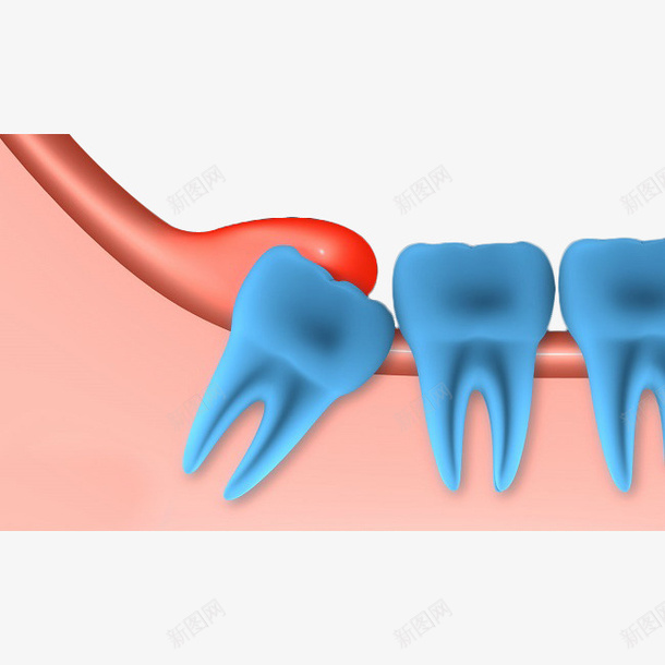 卡通蓝色牙齿智齿牙龈肿痛插画免png免抠素材_88icon https://88icon.com 卡通 卡通蓝色牙齿智齿牙龈肿痛插画免抠免费下载 拔牙 插画 智齿 牙医 牙痛 牙科 牙齿 牙龈 牙龈健康刷牙防蛀牙 肿痛 蓝色