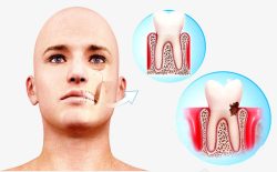 牙齿病变素材