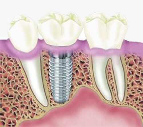 种植牙齿png免抠素材_88icon https://88icon.com 口腔 牙齿 种植 种植牙齿