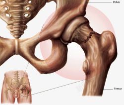 盆骨骨折素材