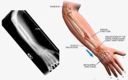 手臂扭伤素材