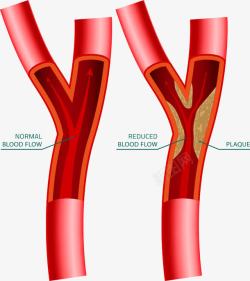 卡通血管血管枝杈高清图片