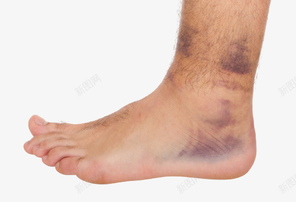 脚部扭伤导致淤血青紫png免抠素材_88icon https://88icon.com 扭伤 淤血 脚伤 脚部