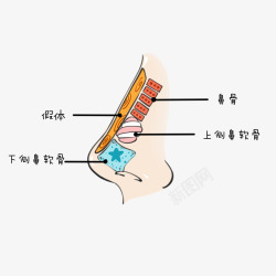 隆鼻假体隆鼻硅胶假体硅胶膨体素材