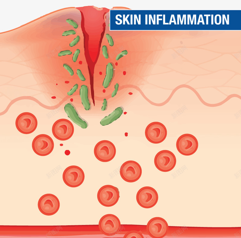 炎症如何帮助皮肤愈合png免抠素材_88icon https://88icon.com 炎症 如何 帮助 皮肤 愈合