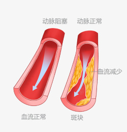 动脉血管对比图素材