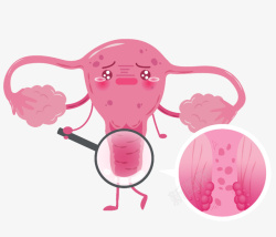 宫颈癌女性宫颈癌变高清图片