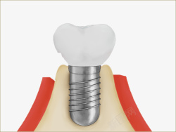 牙齿种植牙口腔素材