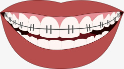 牙齿矫正 微笑 牙齿 牙医 牙科 口 装置 图标 图透明素材