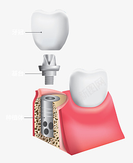 牙齿美白种植牙牙齿医院基台种植图标