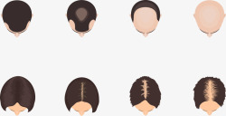 男性女性头顶发量图素材