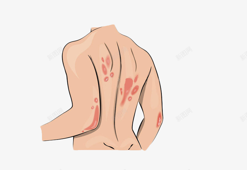 背部皮肤过敏png免抠素材_88icon https://88icon.com 医疗医药 卡通手绘 宣传 皮肤表皮 皮肤过敏 背部过敏 装饰