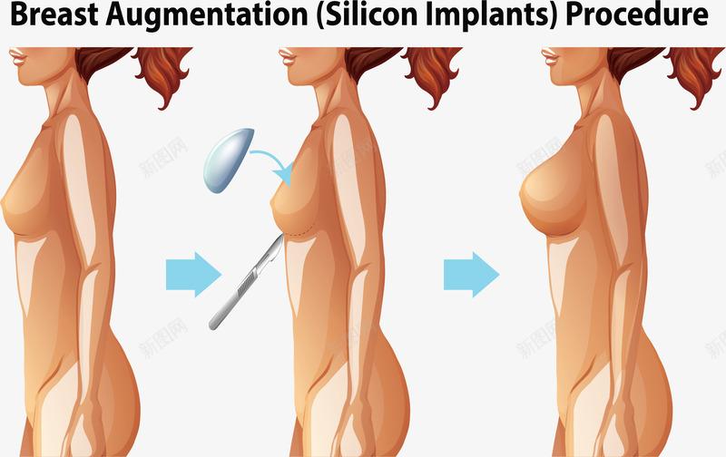 女性医疗隆胸手术矢量图ai免抠素材_88icon https://88icon.com 医疗整形 女性 女性隆胸 矢量png 隆胸 隆胸手术 矢量图