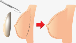 医学美容硅胶隆胸矢量图素材
