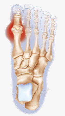 关节炎症趾骨发炎炎症高清图片
