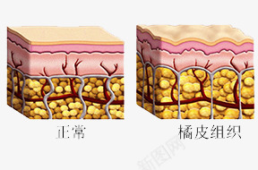 橘皮组织png免抠素材_88icon https://88icon.com 光滑 橘皮组织 皮肤