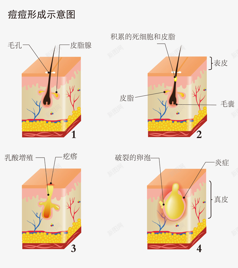 脸部痘痘形成示意图png免抠素材_88icon https://88icon.com 分解 卡通痘痘 毛囊 痘痘 皮肤 皮肤组织 皮肤组织图 皮肤表皮 简图 脸部 表皮