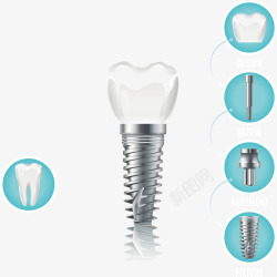 种牙种植牙齿的配件矢量图高清图片
