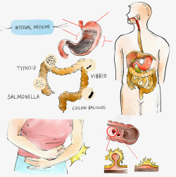 胃部病变医疗插画素材