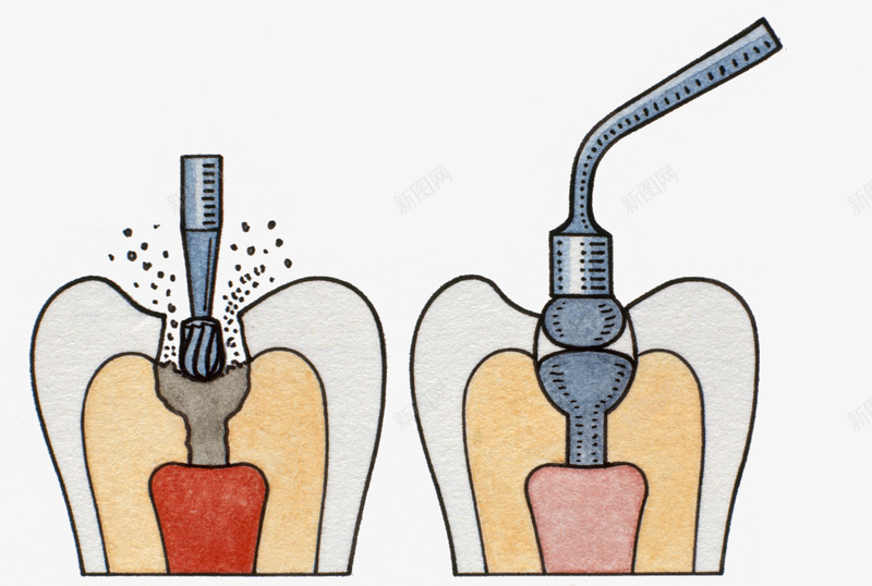 牙根手术插图png免抠素材_88icon https://88icon.com 手术 牙疼 牙钻 生物医学插图