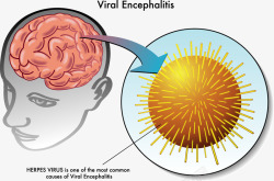 病毒性脑炎病毒性脑炎医学示意图高清图片