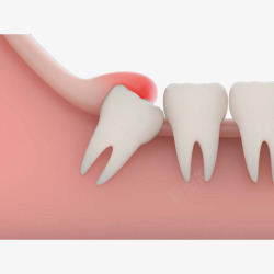 智齿卡通立体智齿牙龈肿痛插画高清图片