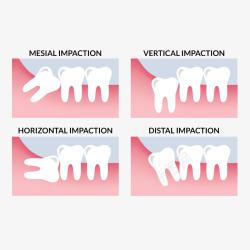牙痛卡通智齿不同生长方向医学插图免高清图片