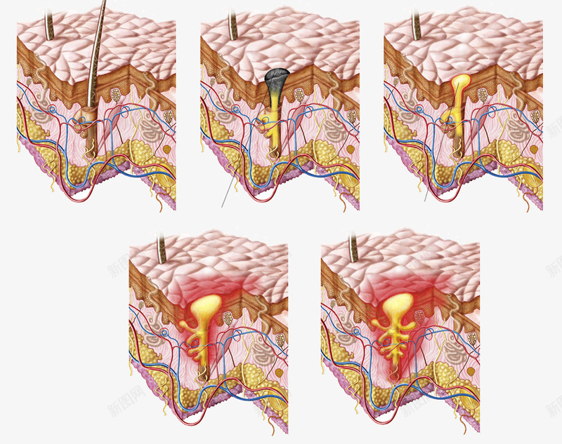 皮肤粉刺png免抠素材_88icon https://88icon.com 汗腺细胞 皮肤结构 皮脂 粉刺