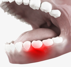 牙肉肿痛效果图素材