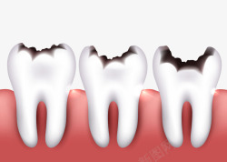 牙龈保护被虫咬坏的牙齿高清图片