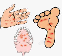 手足口病特征手足口病01图标高清图片