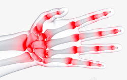 X透视手指关节炎高清图片