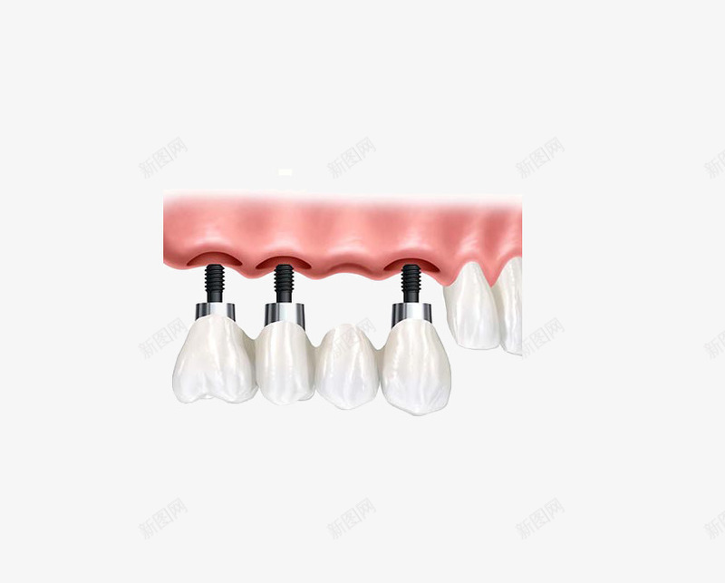 种植牙过程图png免抠素材_88icon https://88icon.com 医院用 示意图 种植牙 钢钉
